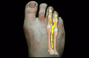 Neuroma Eexcision